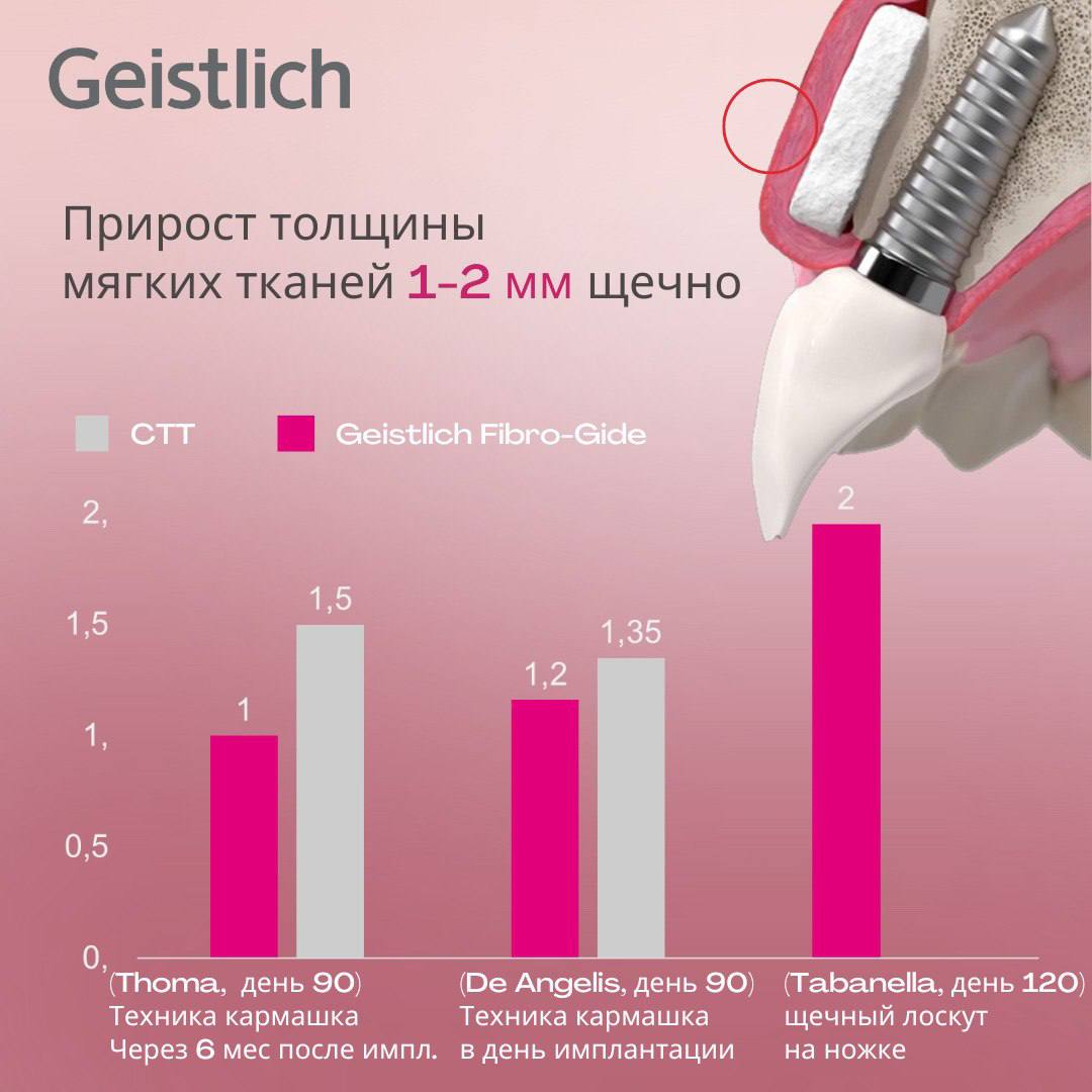 Утолщение мягких тканей при аугментации с применением матрикса Geistlich Fibro-Gide
